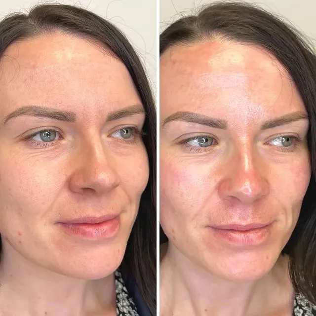 Hydrafacial