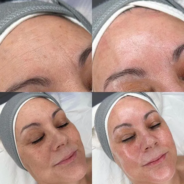 Hydrafacial