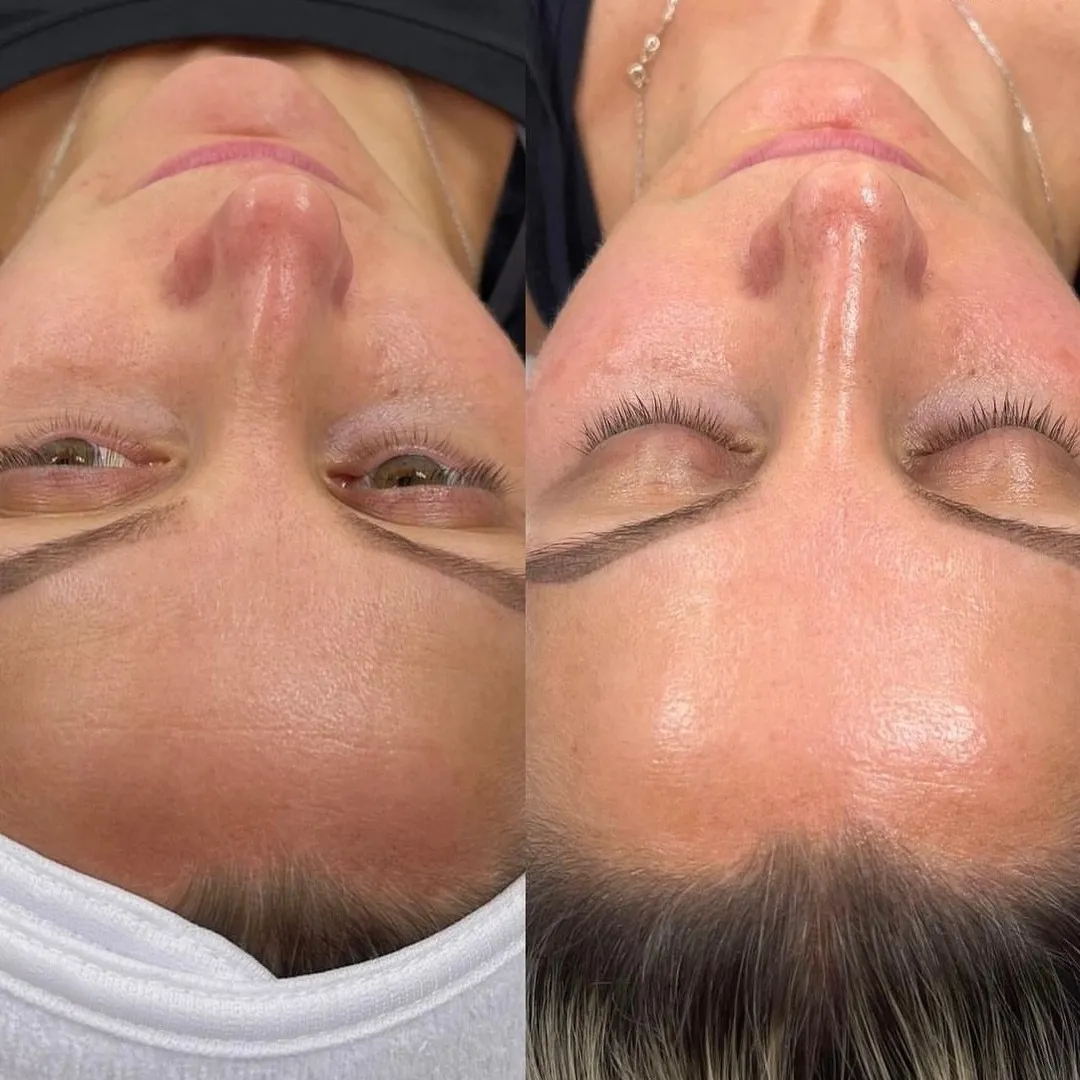 Hydrafacial